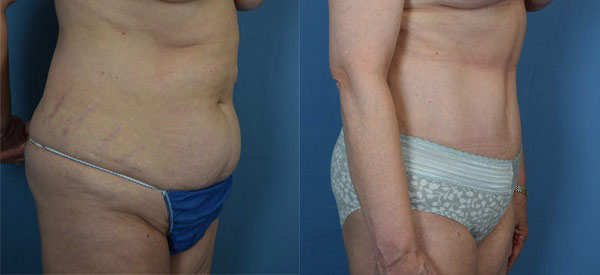 Female body, before and after Tummy Tuck treatment, r-side oblique view, patient 12