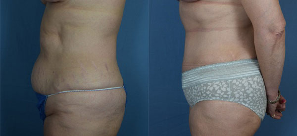 Female body, before and after Tummy Tuck treatment, l-side view, patient 12