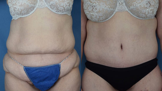 Female body, before and after Tummy Tuck treatment, front view, patient 13