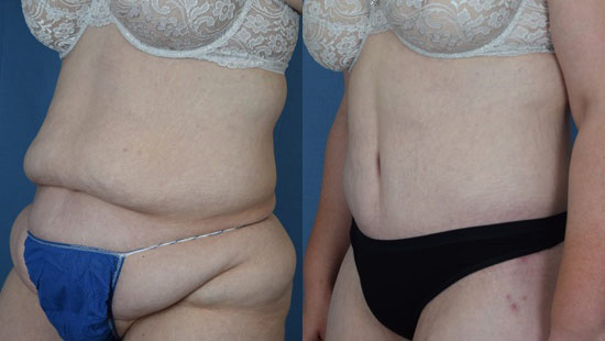 Female body, before and after Tummy Tuck treatment, l-side oblique view, patient 13