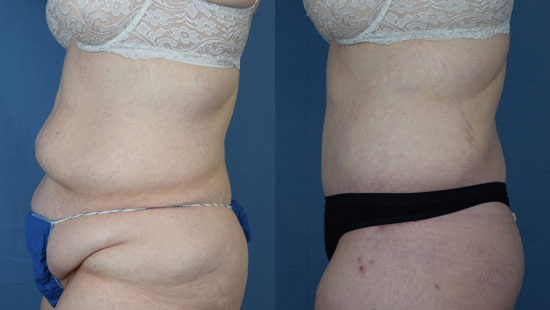 Female body, before and after Tummy Tuck treatment, l-side view, patient 13