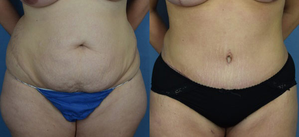 Female body, before and after Tummy Tuck treatment, front view, patient 14