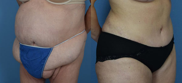 Female body, before and after Tummy Tuck treatment, l-side oblique view, patient 14