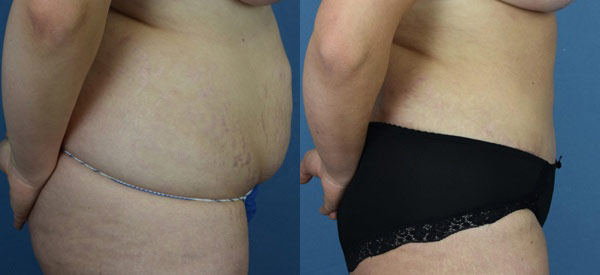 Female body, before and after Tummy Tuck treatment, r-side view, patient 14