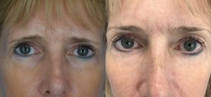 Eyelid Surgery Before & After Patient Miniature Set