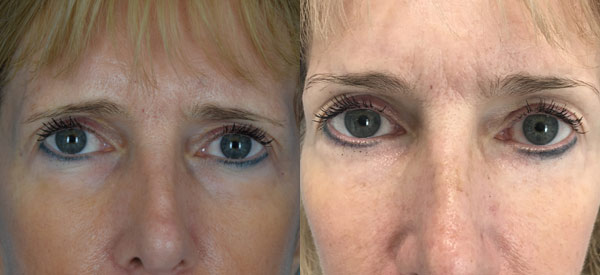 Female face, Eyelid Surgery Before and After treatment photo, front view patient 8