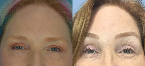 Photo of the patient’s face before & after the Brow Lift surgery. Set 1: Patient 1