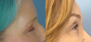 Brow Lift Before & After Patient Miniature Set