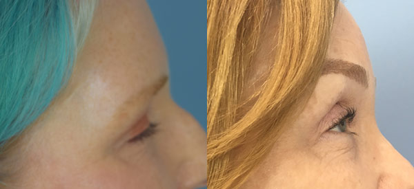Photo of the patient’s face before & after the Brow Lift surgery. Set 2: Patient 1