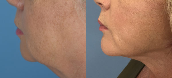 Chin Implant Before & After Patient Set