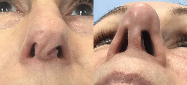 Photo of the patient’s face before & after the Rhinoplasty surgery. Set 1: Patient 2