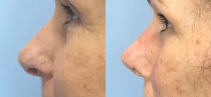 Rhinoplasty Before & After Patient Miniature Set