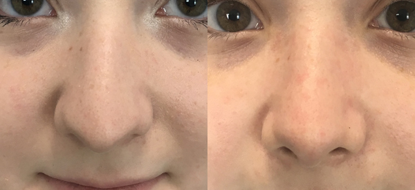 Photo of the patient’s face before & after the Rhinoplasty surgery. Set 1: Patient 3