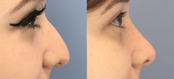 Photo of the patient’s face before & after the Rhinoplasty surgery. Set 3: Patient 3