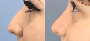 Rhinoplasty Before & After Patient Miniature Set