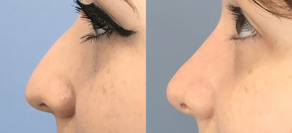 Photo of the patient’s face before & after the Rhinoplasty surgery. Set 2: Patient 3