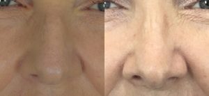 Rhinoplasty Before & After Patient Miniature Set