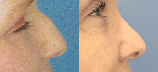 Photo of the patient’s face before & after the Rhinoplasty surgery. Set 3: Patient 16