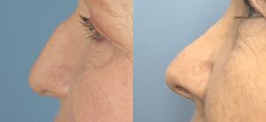 Rhinoplasty Before & After Patient Miniature Set