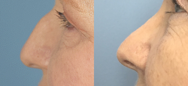 Photo of the patient’s face before & after the Rhinoplasty surgery. Set 2: Patient 16