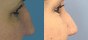 Rhinoplasty Before & After Patient Miniature Set