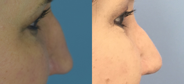 Photo of the patient’s face before & after the Rhinoplasty surgery. Set 1: Patient 4