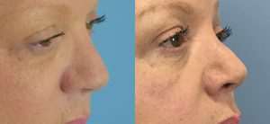 Rhinoplasty Before & After Patient10