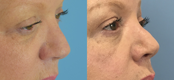 Rhinoplasty Before & After Patient Set
