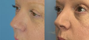 Rhinoplasty Before & After Patient Miniature Set