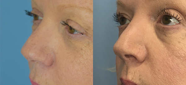 Rhinoplasty Before & After Patient Set