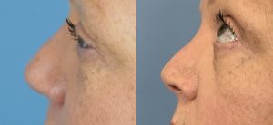 Rhinoplasty Before & After Patient Miniature Set