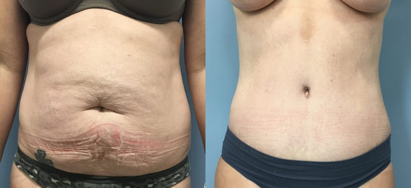 Female body, before and after Tummy Tuck treatment, front view, patient 3