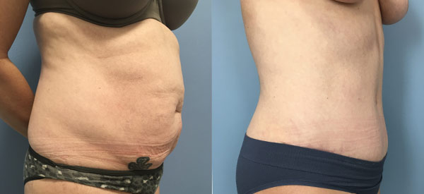Female body, before and after Tummy Tuck treatment, r-side oblique view, patient 3