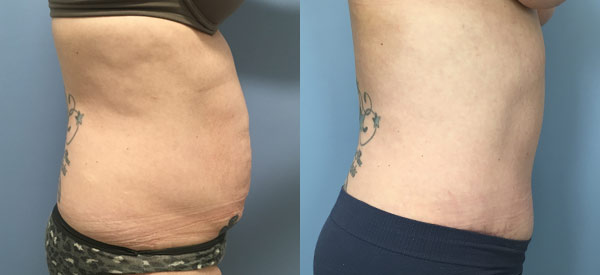 Female body, before and after Tummy Tuck treatment, r-side view, patient 3