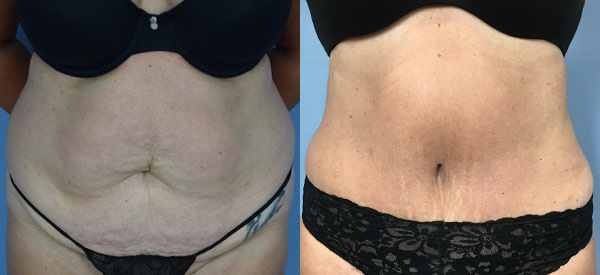 Female body, before and after Tummy Tuck treatment, front view, patient 7