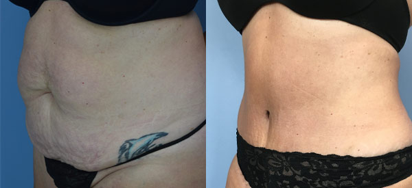 Female body, before and after Tummy Tuck treatment, l-side oblique view, patient 7