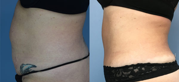 Female body, before and after Tummy Tuck treatment, l-side view, patient 7