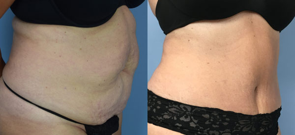 Female body, before and after Tummy Tuck treatment, r-side oblique view, patient 7