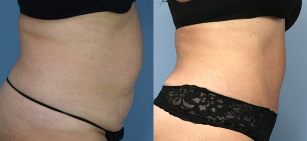 Female body, before and after Tummy Tuck treatment, r-side view, patient 7