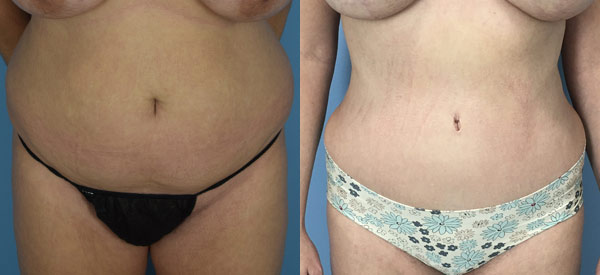 Female body, before and after Tummy Tuck treatment, front view, patient 5