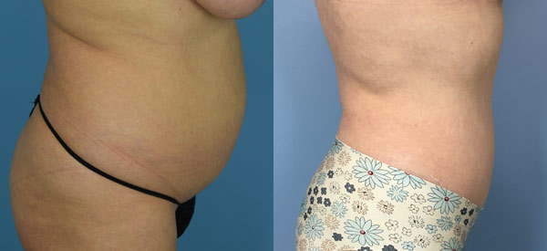Female body, before and after Tummy Tuck treatment, r-side view, patient 5