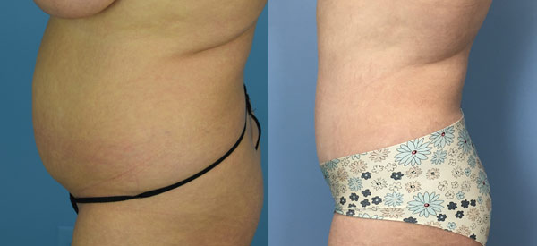 Female body, before and after Tummy Tuck treatment, l-side view, patient 5