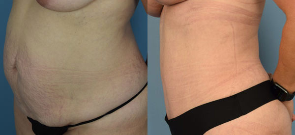 Female body, before and after Tummy Tuck treatment, l-side oblique view, patient 4