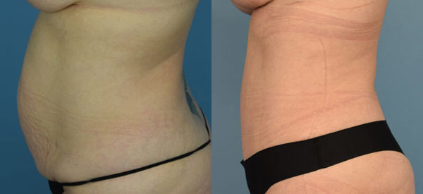Female body, before and after Tummy Tuck treatment, l-side view, patient 4
