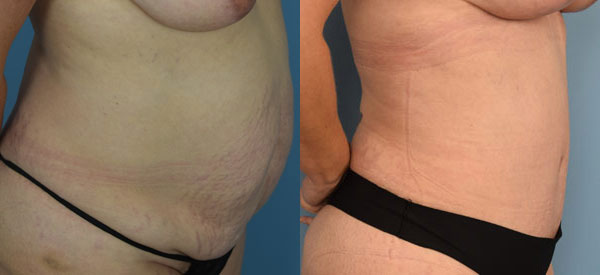 Female body, before and after Tummy Tuck treatment, r-side view, patient 4