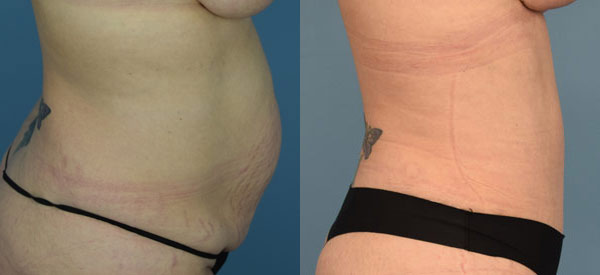 Female body, before and after Tummy Tuck treatment, r-side oblique view, patient 4