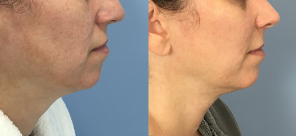 Chin Implant Before & After Patient Set
