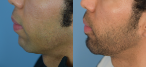 Chin Implant Before & After Patient4