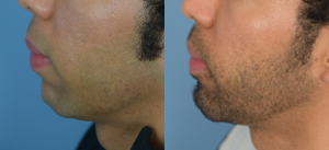 Chin Implant Before & After Patient Miniature Set
