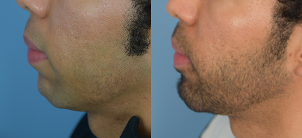 Photo of the patient’s face before & after the Chin Implant surgery. Set 1: Patient 3